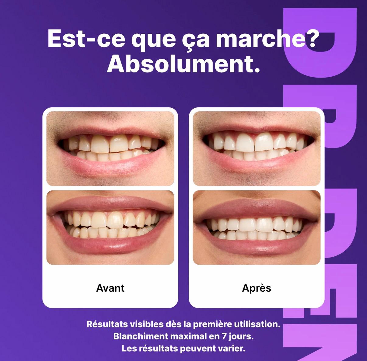 Bandes Blanchissantes - Résultats Visibles dès la 1ère semaine