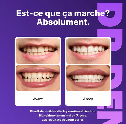 Bandes Blanchissantes - Résultats Visibles dès la 1ère semaine